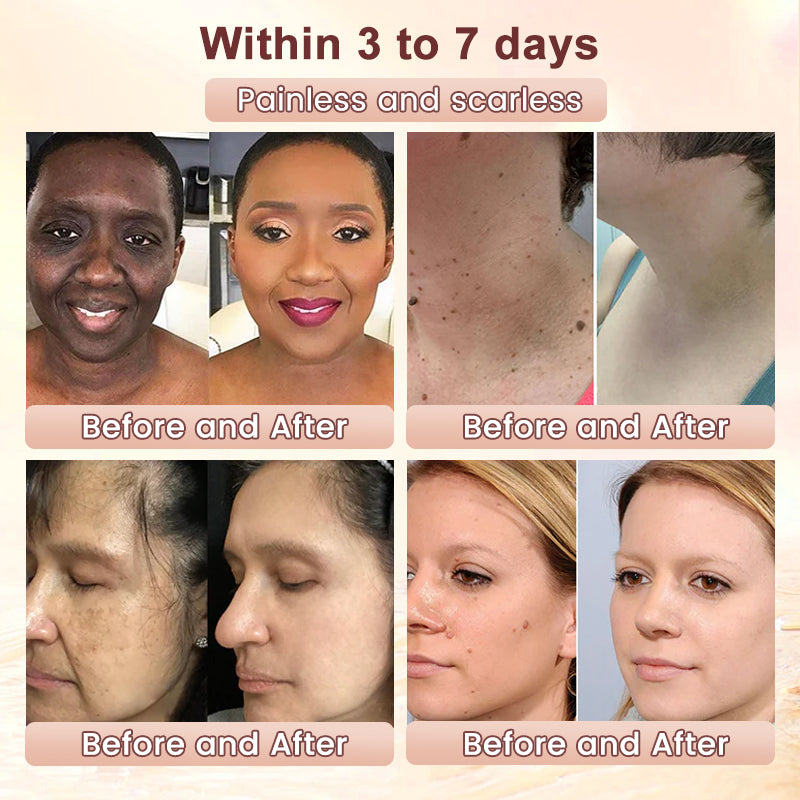 🍀Furzero™️ Quarxery Purifying Enzymes Exfoliating Gel (Also Cure Acanthosis Nigricans)💟