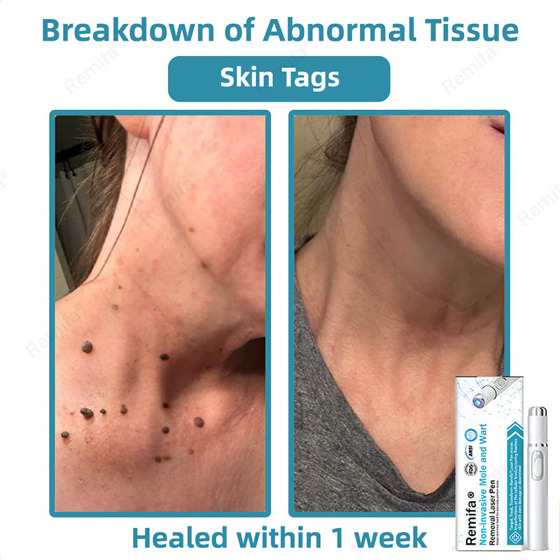 Remifa®🖊️Non-invasive Skin Spot & Tag Care Pen – Promax