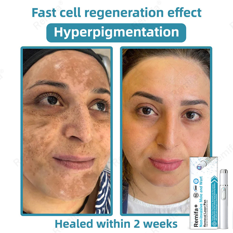 Remifa®🖊️Non-invasive Skin Spot & Tag Care Pen – Promax
