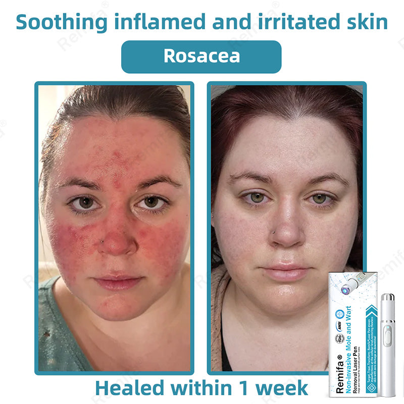 Remifa®🖊️Non-invasive Skin Spot & Tag Care Pen – Promax