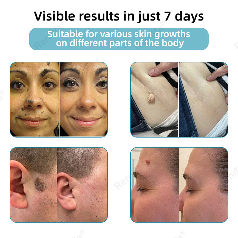 Remifa®🖊️Non-invasive Skin Spot & Tag Care Pen – Promax