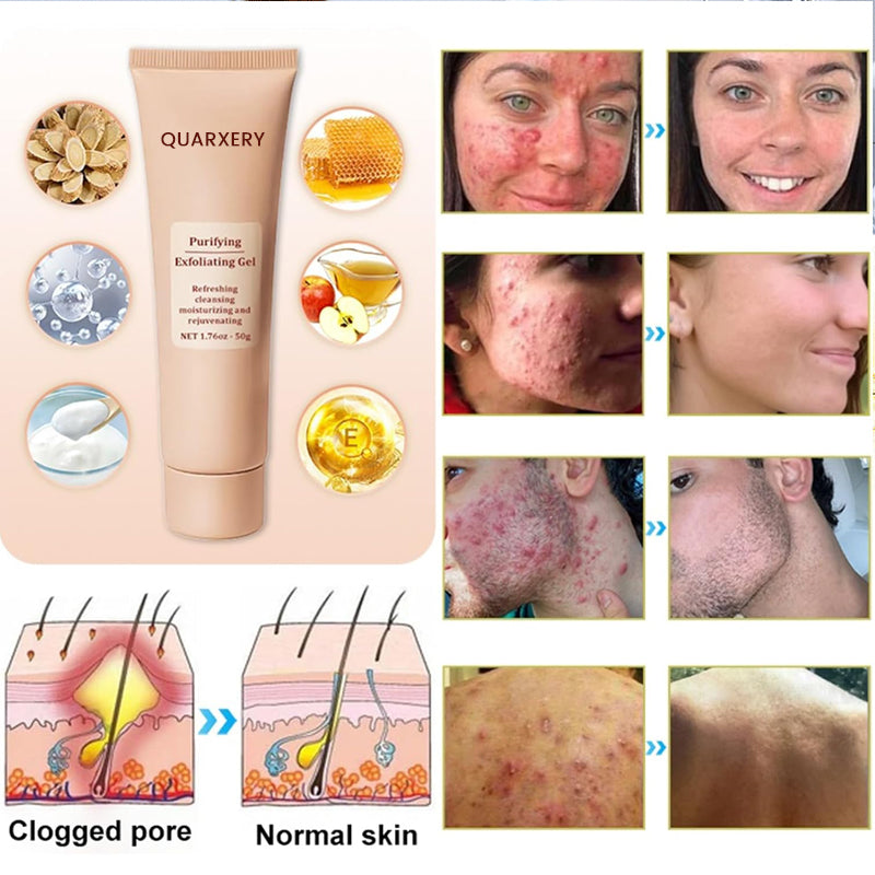 🍀Furzero™️ Quarxery Purifying Enzymes Exfoliating Gel (Also Cure Acanthosis Nigricans)💟